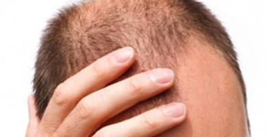 كيف تعرف ما إذا كنت على وشك الإصابة بالصلع، وكيف تمنع ذلك؟