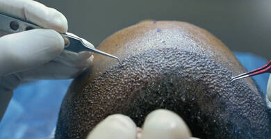 FUE vs. DHI Hair Transplant in Turkey: Understanding the Differences & Choosing the Right Option