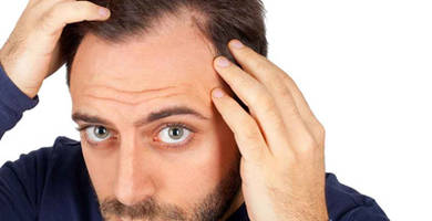 أسئلة وأجوبه عن زراعة الشعر