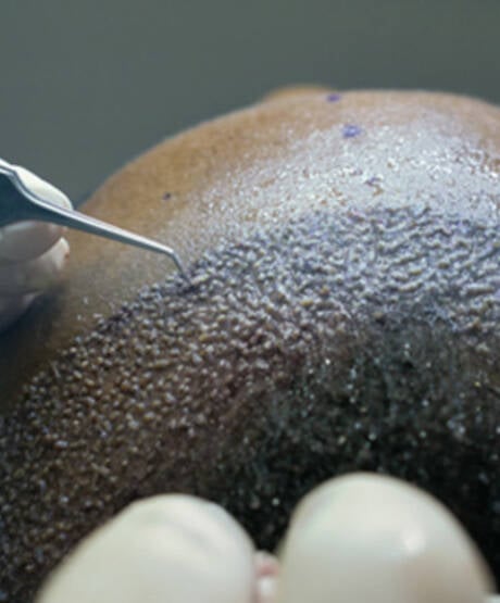 FUE vs. DHI Hair Transplant in Turkey: Understanding the Differences & Choosing the Right Option