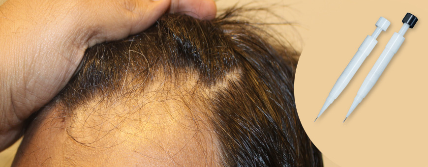 ▷ DHI Hair Transplant in Istanbul, Turkey, with Choi Pen