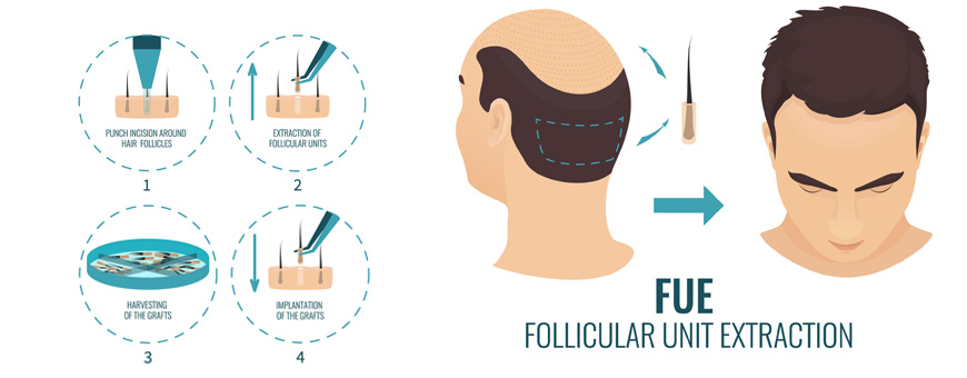 ▷ Side Effects of the FUE Treatment in Hair Transplants