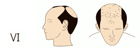 The Norwood Scale and the Hair Loss - Clinicana