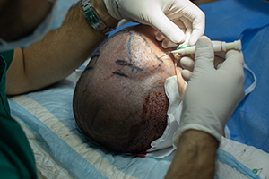 Greffe de cheveux Turquie DHI