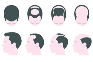 Was ist die Norwood-Skala?